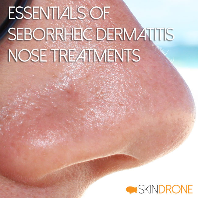 seborrheic dermatitis treatments