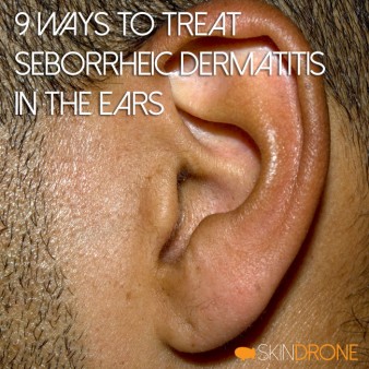 9 Ways to Treat Seborrheic Dermatitits in Ears Cover Photo